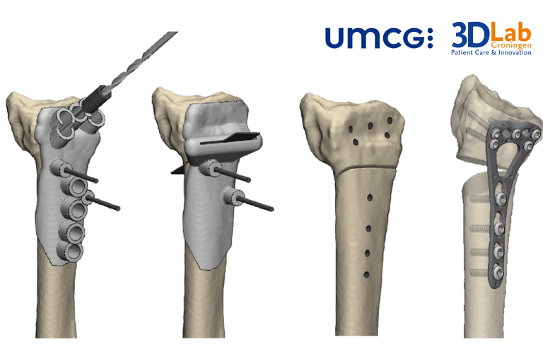 How 3D Technology is Changing Surgery
